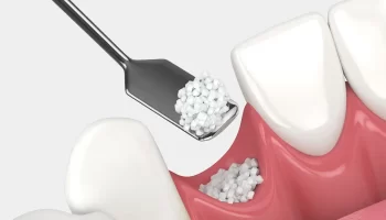 Dental Bone Grafting: All You Need to Know