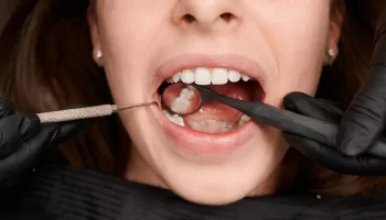 How to Choose the Right Type of Dental Filling for Your Tooth